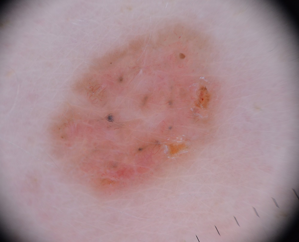 Imagen Dermatoscopica