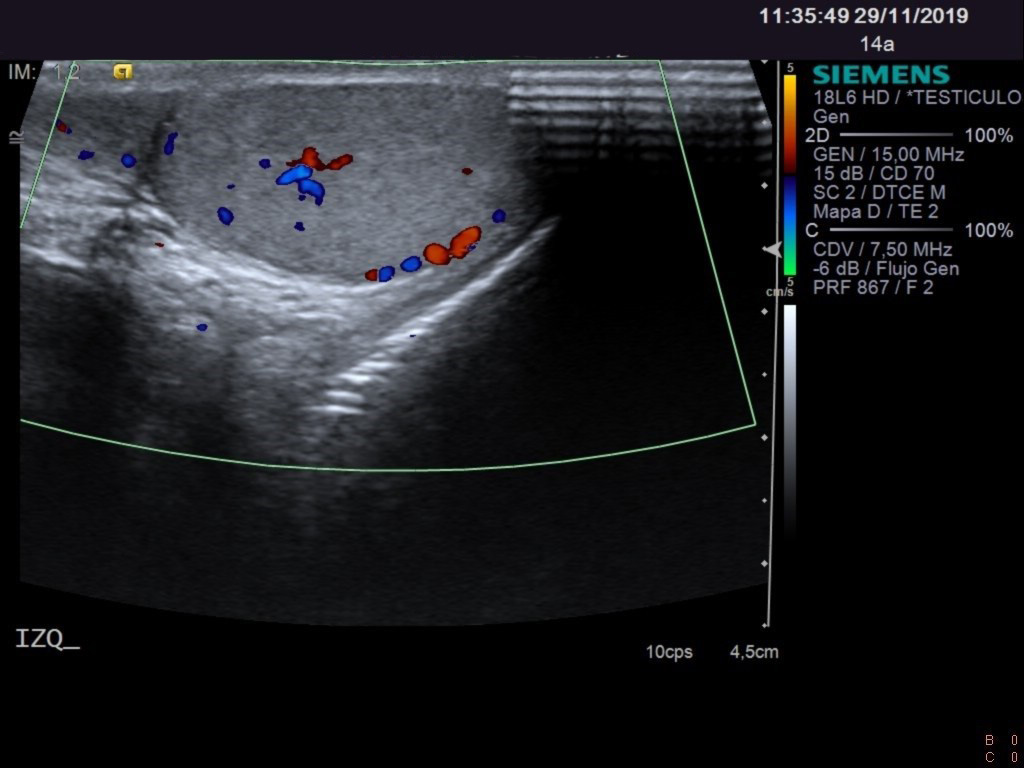 Corte longitudinal de testículo izquierdo con doppler color (imagen 1) 
