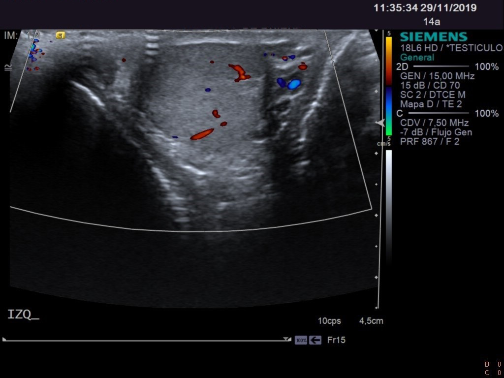 Corte transversal del testículo izquierdo con doppler color (imagen 2)