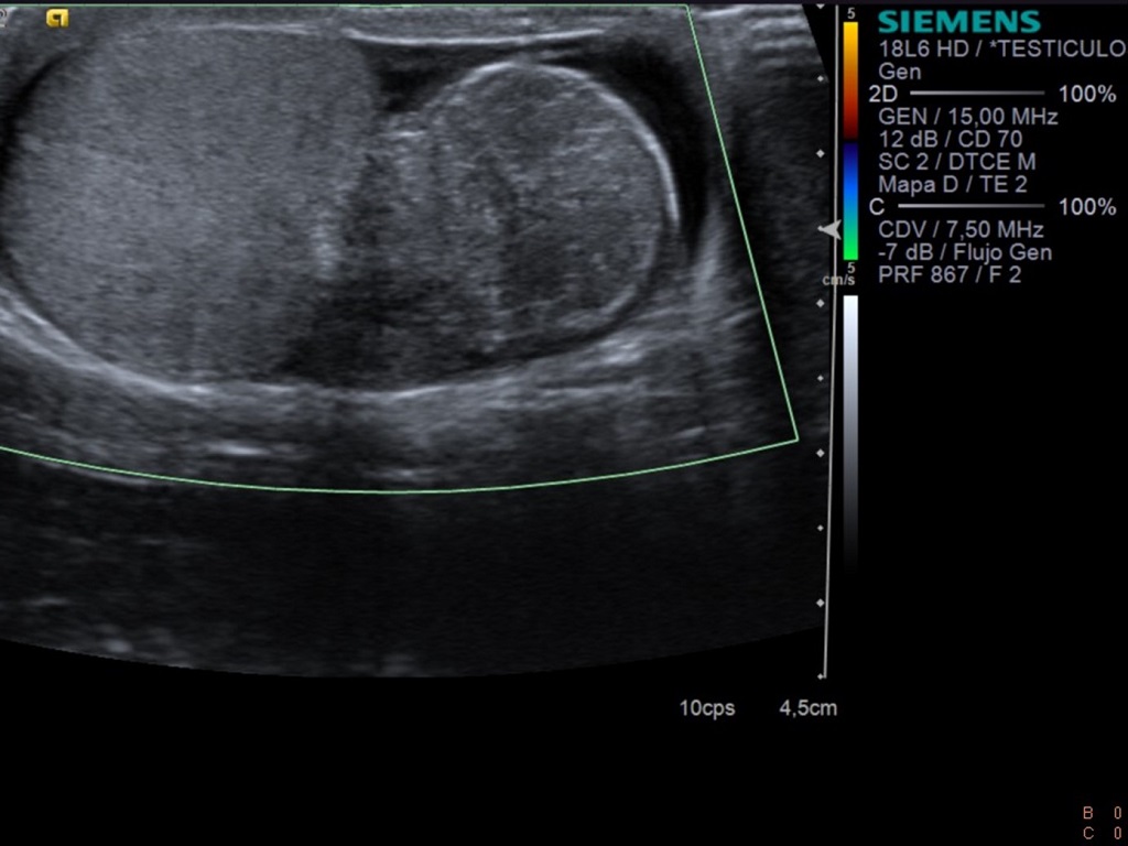 Corte transversal de testículo derecho con doppler color (imagen 5)