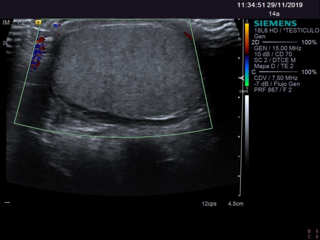 Corte longitudinal de testículo derecho con doppler color (imagen 6)